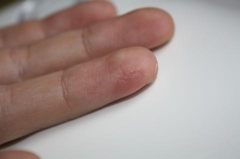 Finger 1 - (Finger, trockene Haut, rissige Haut)