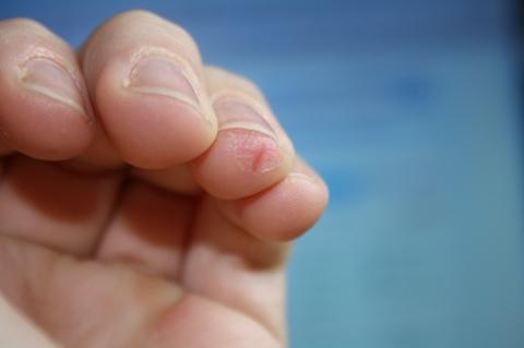 Finger 2 - (Finger, trockene Haut, rissige Haut)