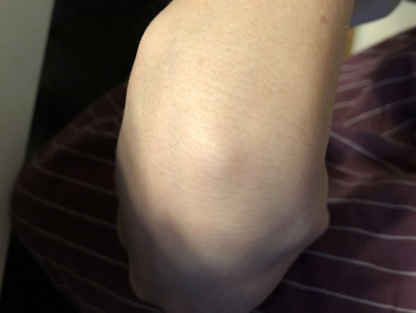 Ganglion Verschwindet Gesundheit Und Medizin Medizin Chirurgie Ganglion Verschwindet Gesundheit Und Medizin Medizin Chirurgie