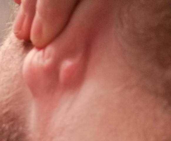 Ganz Dicke Verhartung Hinter Dem Ohr Gesundheit Ganz Dicke Verhartung Hinter Dem Ohr Gesundheit