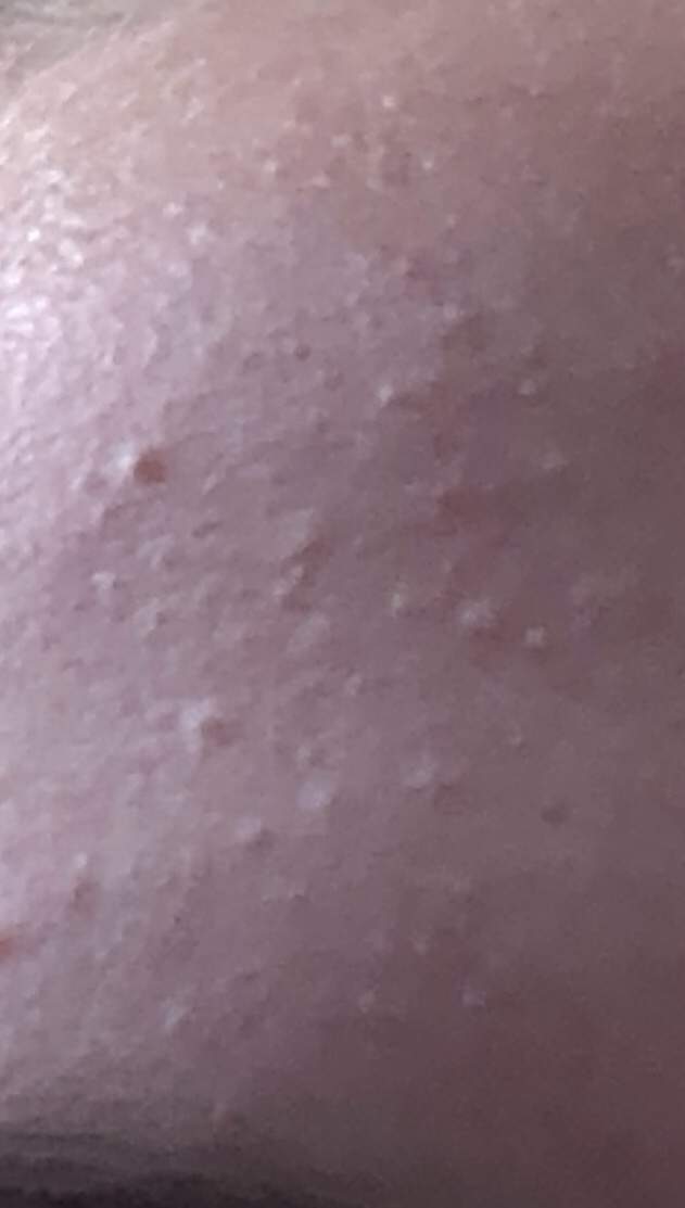 Ganz kleine Pickel auf der Stirn, was ist das? (Haut)