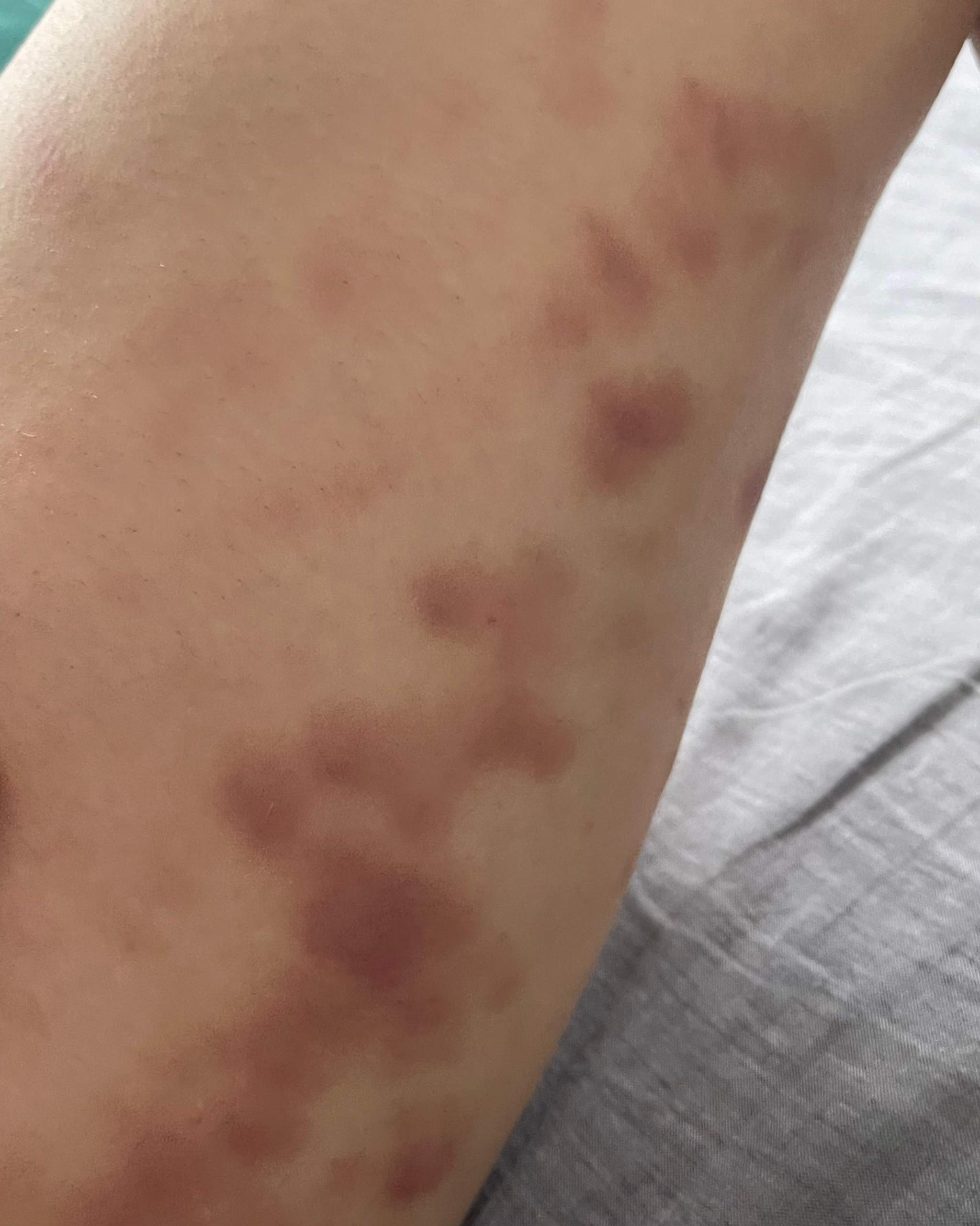Ganz viele Hämatome an den Beinen nach Massage? (Gesundheit und
