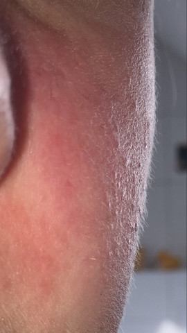 Ganz Viele Kleine Pickel Nach Sonne Gesundheit Und Medizin Kleine Pickel Ganz Viele Kleine Pickel Nach Sonne Gesundheit Und Medizin Kleine Pickel