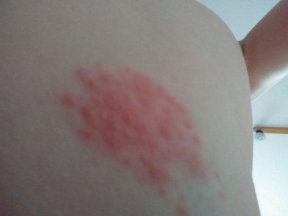 Ganz viele stiche neben einander in der nacht? (Insekten, Stich, Bisse) Ganz viele stiche neben einander in der nacht? (Insekten, Stich, Bisse)