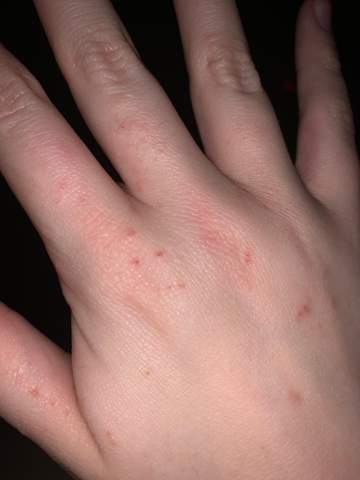 Was Tun Bei Juckreiz Am Korper Was Tun Bei Juckreiz Am Korper