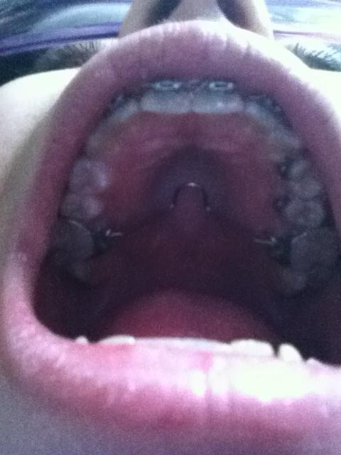 Gaumenbügel…-.- (Zahnspange, Gaumen)