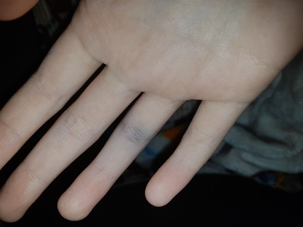 Gebrochener Fimger Gesundheit Und Medizin Finger Gebrochen Gebrochener Fimger Gesundheit Und Medizin Finger Gebrochen