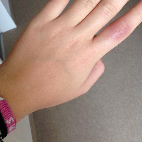 Gebrochener Finger Hilfeeeee Arzt Gebrochen Gebrochener Finger Hilfeeeee Arzt Gebrochen