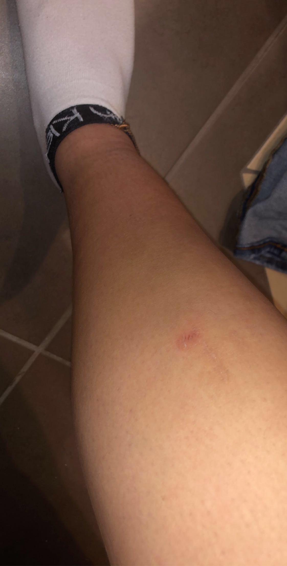 Gegen Eine Bank Gelaufen Jetzt Schmerzen Und Beule Beine Schienbein Gegen Eine Bank Gelaufen Jetzt Schmerzen Und Beule Beine Schienbein