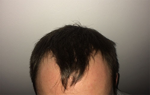 Vor der OP - (Haare, Türkei, haartransplantation)