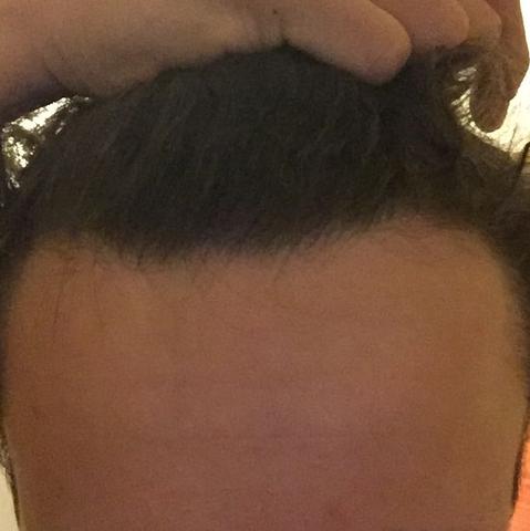 Geheimratsecken Haarausfall Mit 16 Haare Arzt Frisur