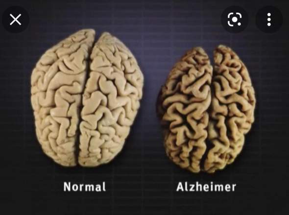 Gehirn Modellbau Chorea Huntington ähnlich wie Alzheimer?