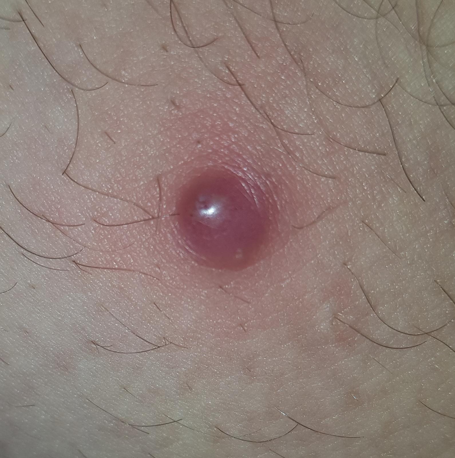 Geht Ein Blutohr Von Alleine Weg geht das von alleine weg, was ist das (achtung etwas eklig