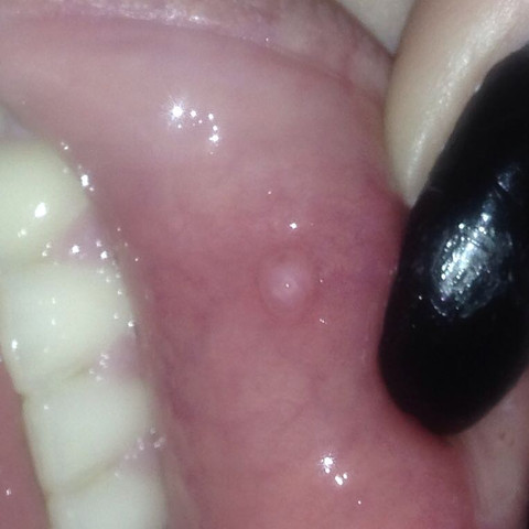Was Mache Ich Gegen Gelblaschen An Der Lippe Blase Gel Was Mache Ich Gegen Gelblaschen An Der Lippe Blase Gel