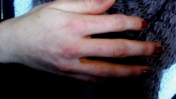 Gelb Braune Flecken Auf Der Hand Haut Antibiotika Braun