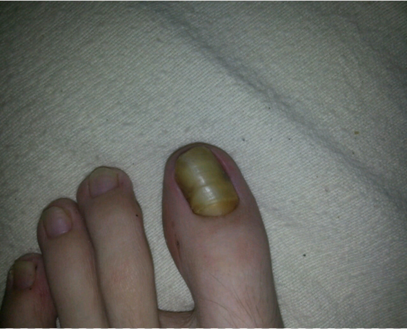 Gelb Verfarbter Fussnagel Ist Das Krankheit Fusse Pilze