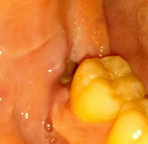 Gelbe Ablagerung in Weisheitszahn-Mulde - (Medizin, Zähne, Operation)