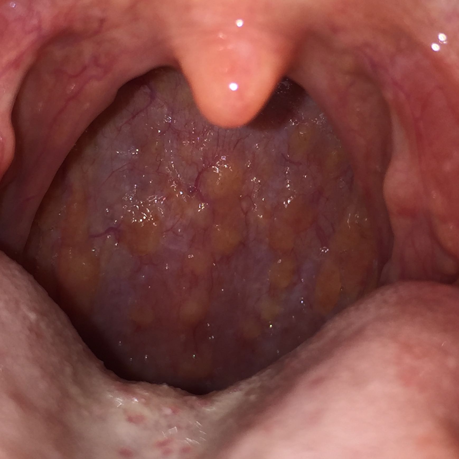 Gelbe Bläschen im Hals, kein Appetit und kein Geschmackssinn außerdem Gelbe Bläschen im Hals, kein Appetit und kein Geschmackssinn außerdem