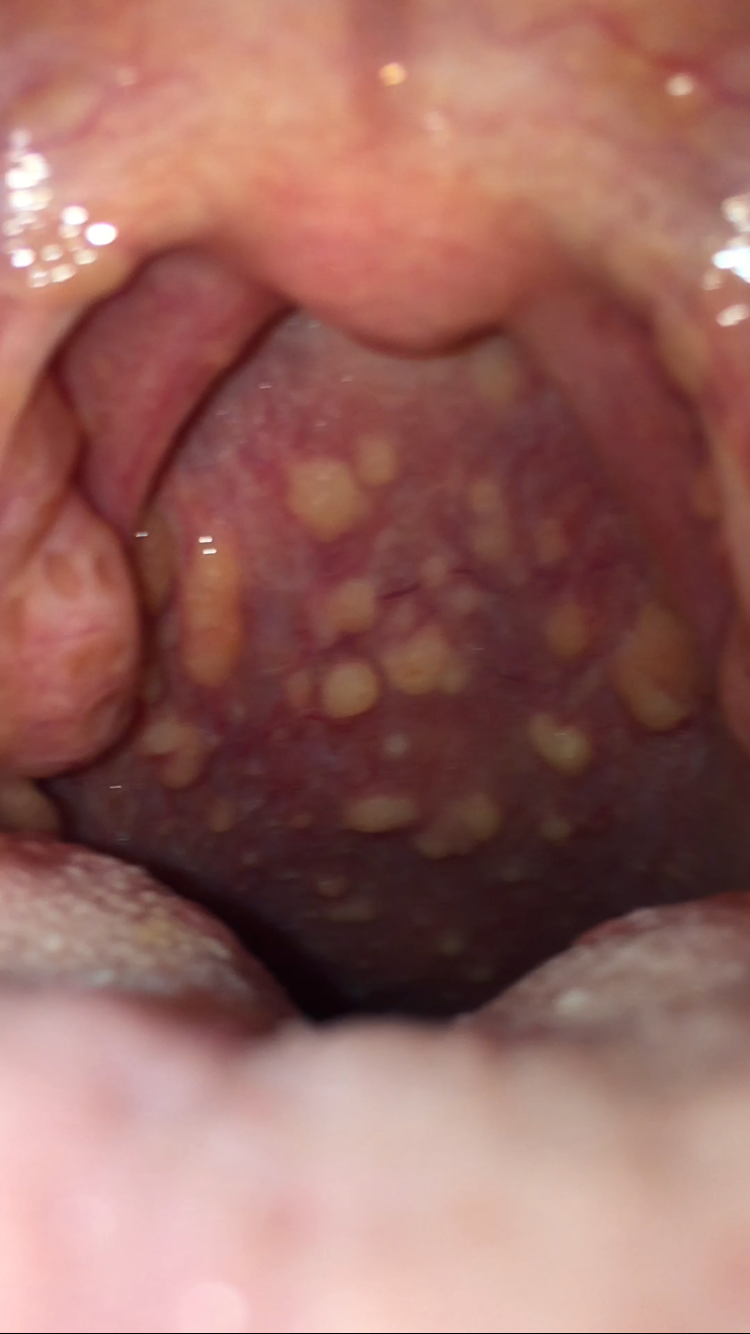 Gelbe Bläschen im hals, nur noch am husten? (Gesundheit, Medizin, Körper) Gelbe Bläschen im hals, nur noch am husten? (Gesundheit, Medizin, Körper)