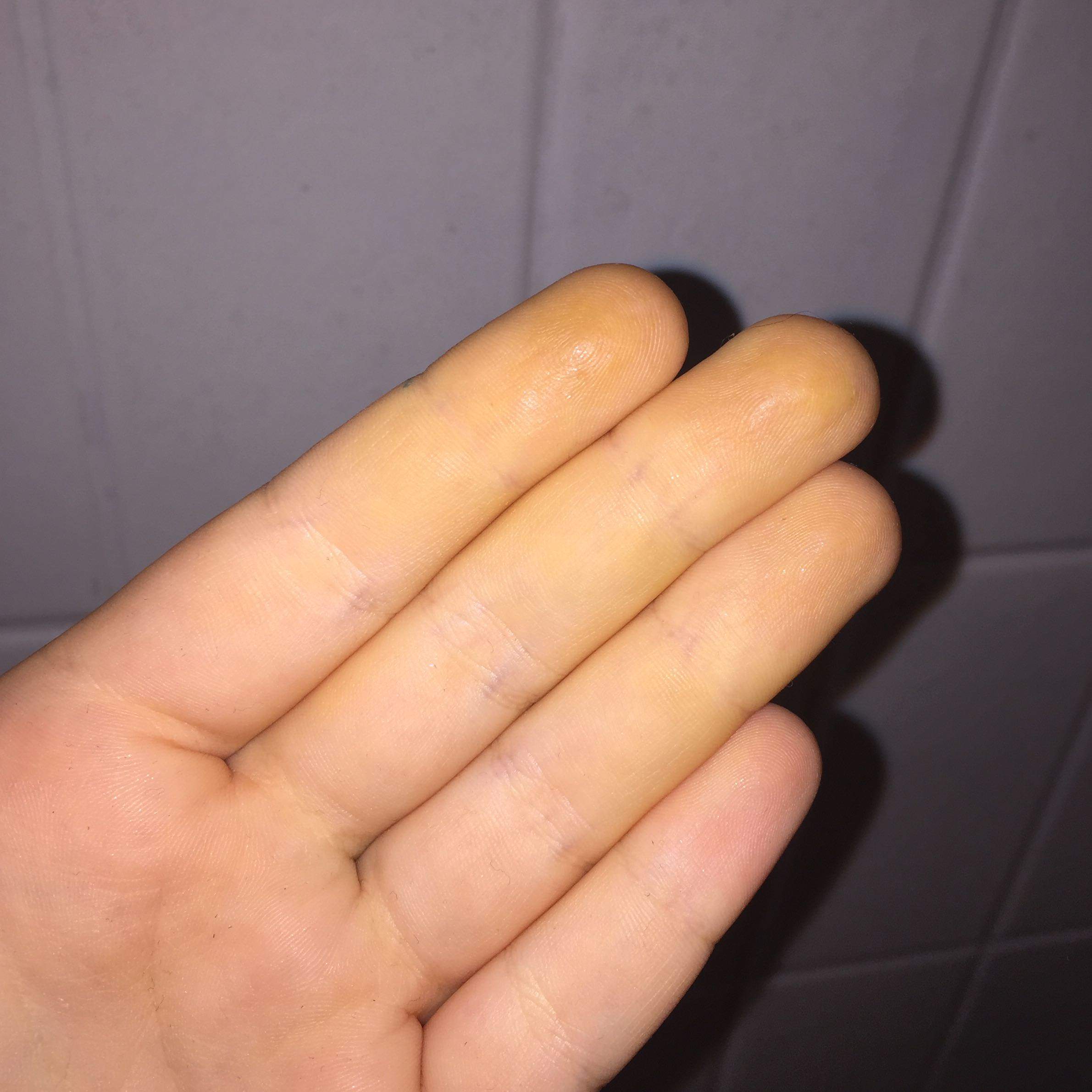 Finger Innen Rillen Gelbe Finger innen? (Gesundheit, gelb, Orthomol)