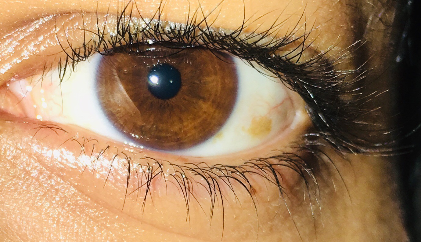 gelbe Flecke im Auge, was kann der Grund sein (Foto)? (Gesundheit und Medizin, Gesundheit, Liebe gelbe Flecke im Auge, was kann der Grund sein (Foto)? (Gesundheit und Medizin, Gesundheit, Liebe