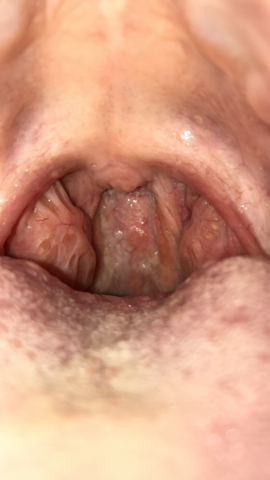 Gelbe Flecken An Den Mandeln Medizin Hno Gelbe Flecken An Den Mandeln Medizin Hno