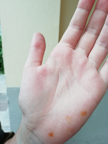 Gelbe Flecken An Der Handinnenflache Krankheit Haut
