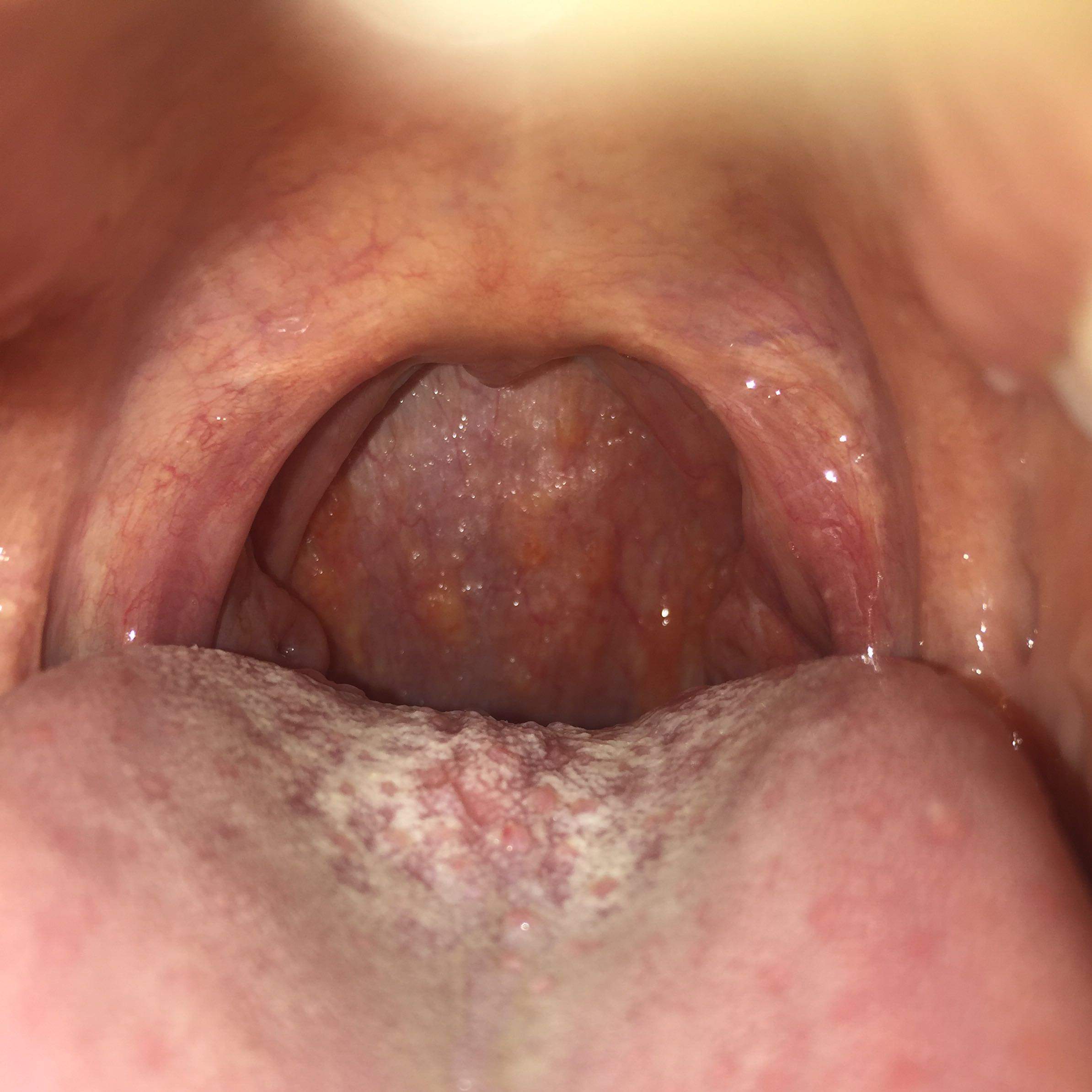 Gelbe Flecken An Der Rachenwand Gesundheit Und Medizin Gelb Rachen Gelbe Flecken An Der Rachenwand Gesundheit Und Medizin Gelb Rachen