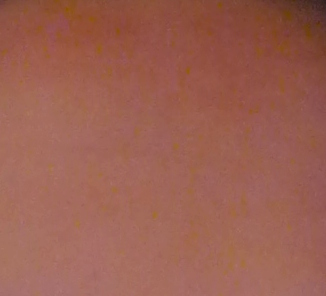 Gelbe Flecken auf der Haut (Fotos) (Fotografie, Bildbearbeitung)