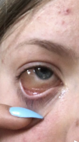 Gelbe Flussigkeit Im Auge Gesundheit Und Medizin Augen Gelbe Flussigkeit Im Auge Gesundheit Und Medizin Augen