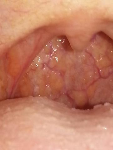 Was sind das für gelbe Punkte im Hals/ Rachen? (Gesundheit, Entzündung