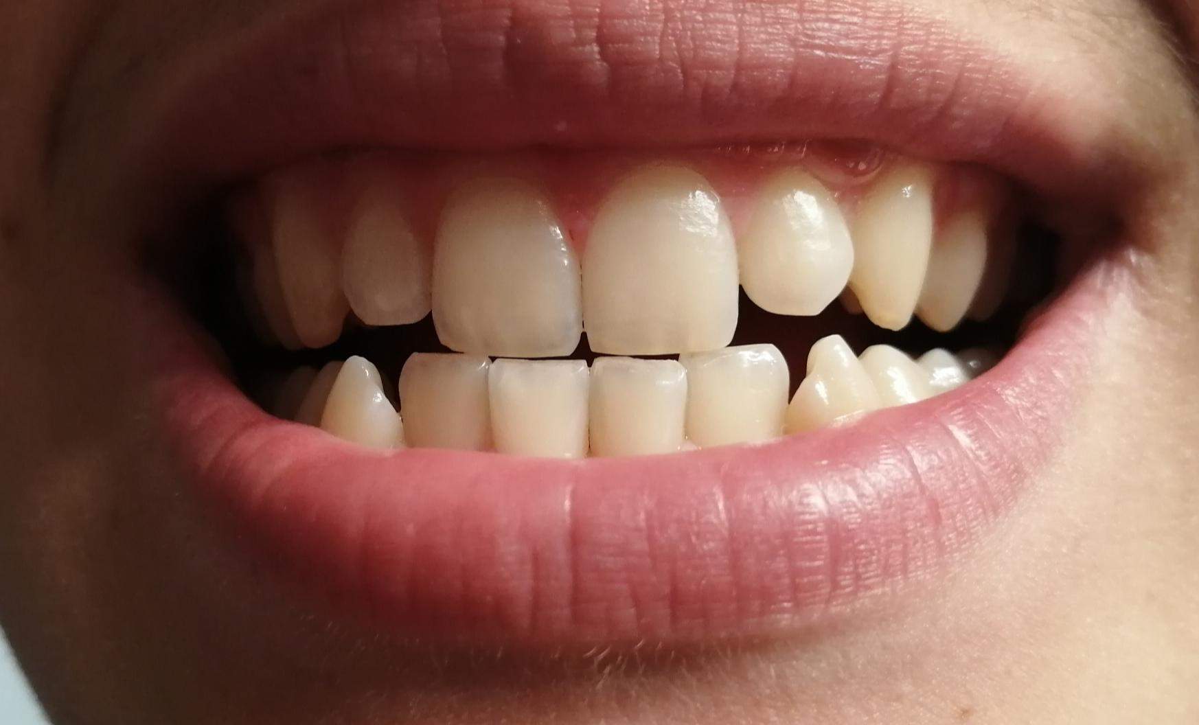 Gelbe Zähne? (Gesundheit und Medizin, Gesundheit, Medizin)