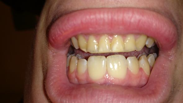 Gelbe Zahnverfarbung Zahne Verfarbung Weisser Gelbe Zahnverfarbung Zahne Verfarbung Weisser