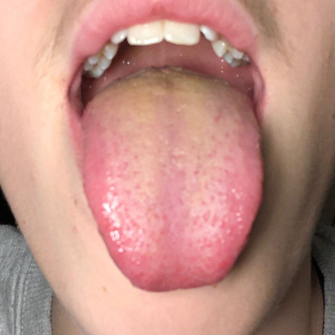 Gelbe Zunge - (Gesundheit und Medizin, Arzt, Zunge)