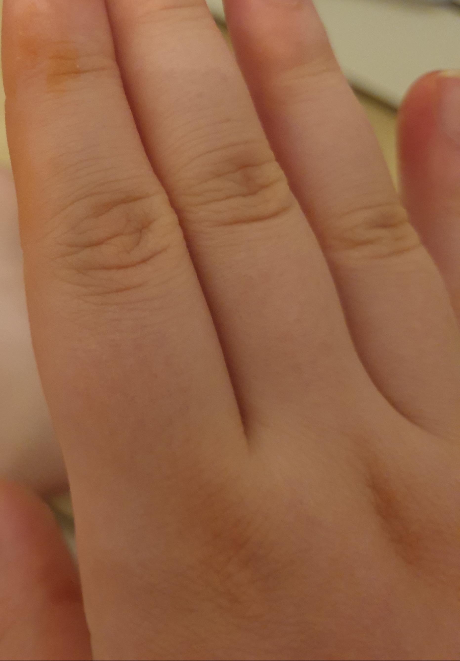 Gelbe/Orange Flecken auf der Hand SSW 36? (Gesundheit und Medizin, Schwangerschaft, Hautprobleme) Gelbe/Orange Flecken auf der Hand SSW 36? (Gesundheit und Medizin, Schwangerschaft, Hautprobleme)