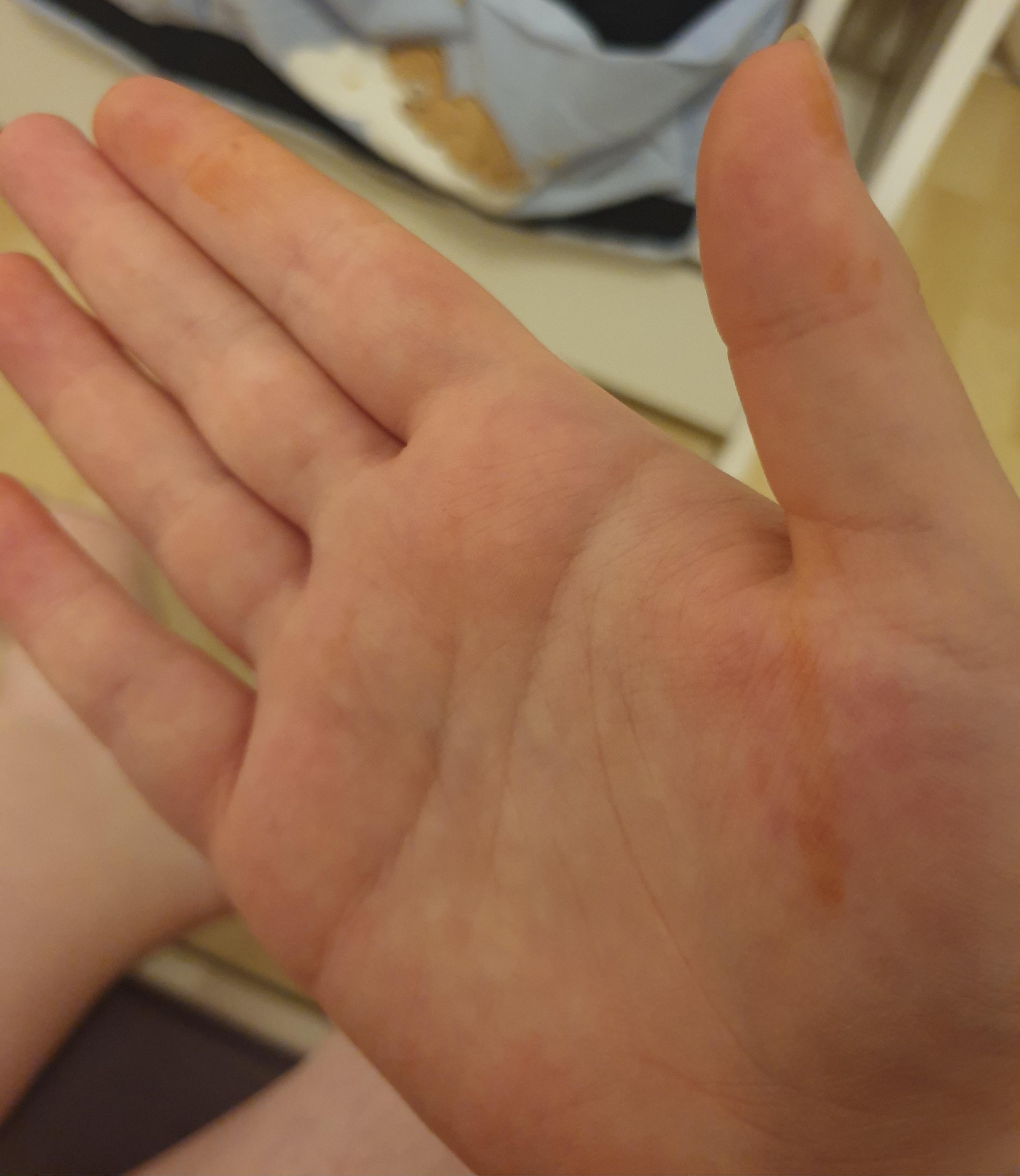 Gelbe/Orange Flecken auf der Hand SSW 36? (Gesundheit und Medizin, Schwangerschaft, Hautprobleme) Gelbe/Orange Flecken auf der Hand SSW 36? (Gesundheit und Medizin, Schwangerschaft, Hautprobleme)