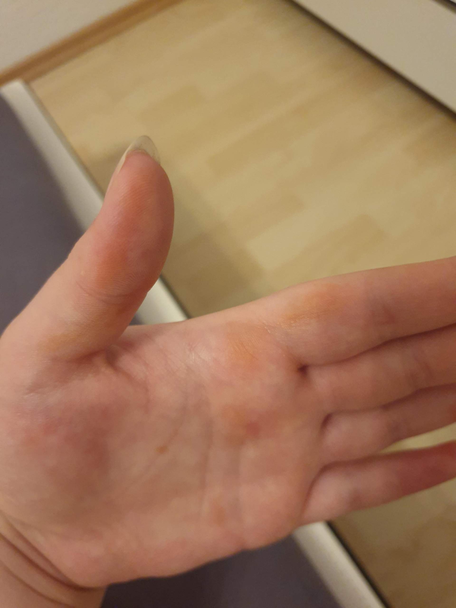 Orange Flecken Auf Der Hand Ursache Gelbe/Orange Flecken auf der Hand SSW 36? (Gesundheit und Medizin