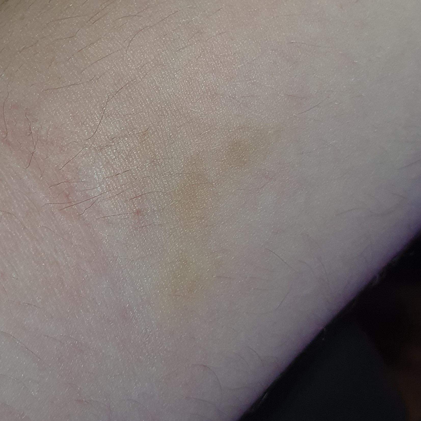 Gelber Fleck am Arm bedeutet? (Gesundheit und Medizin, Medizin, Körper)
