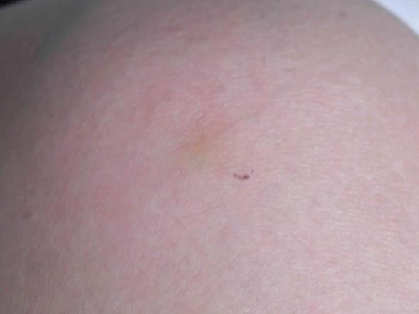 Gelber Fleck Am Bein Nah Am Knie Was Könnte Es Sein Gelber Fleck Am Bein Nah Am Knie Was Könnte Es Sein