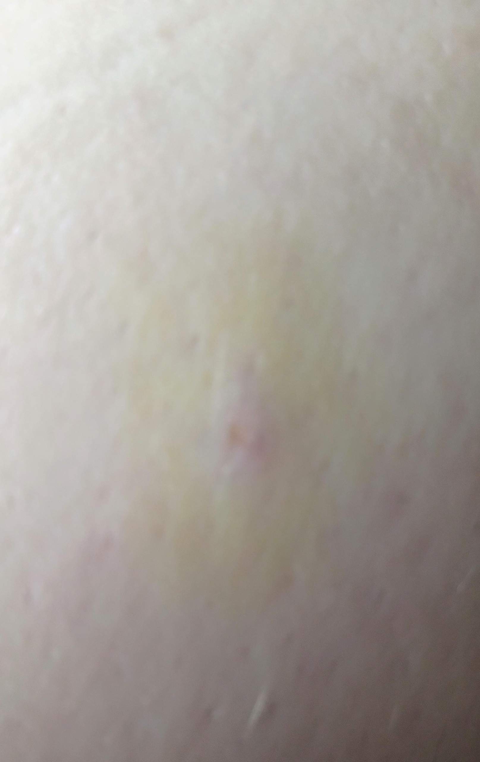 Gelben Fleck Auf Der Haut