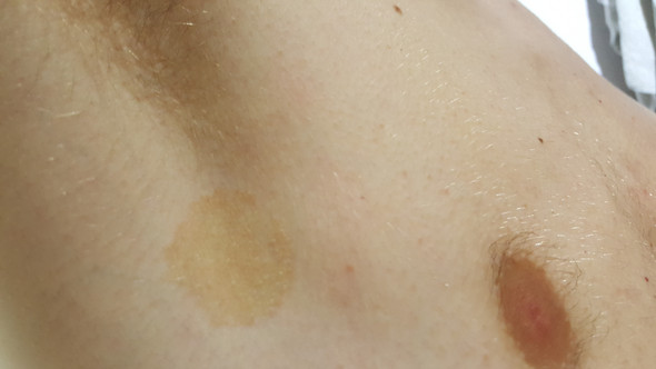 Gelber Pigmentfleck auf der Haut? (Gesundheit und Medizin, Gesundheit