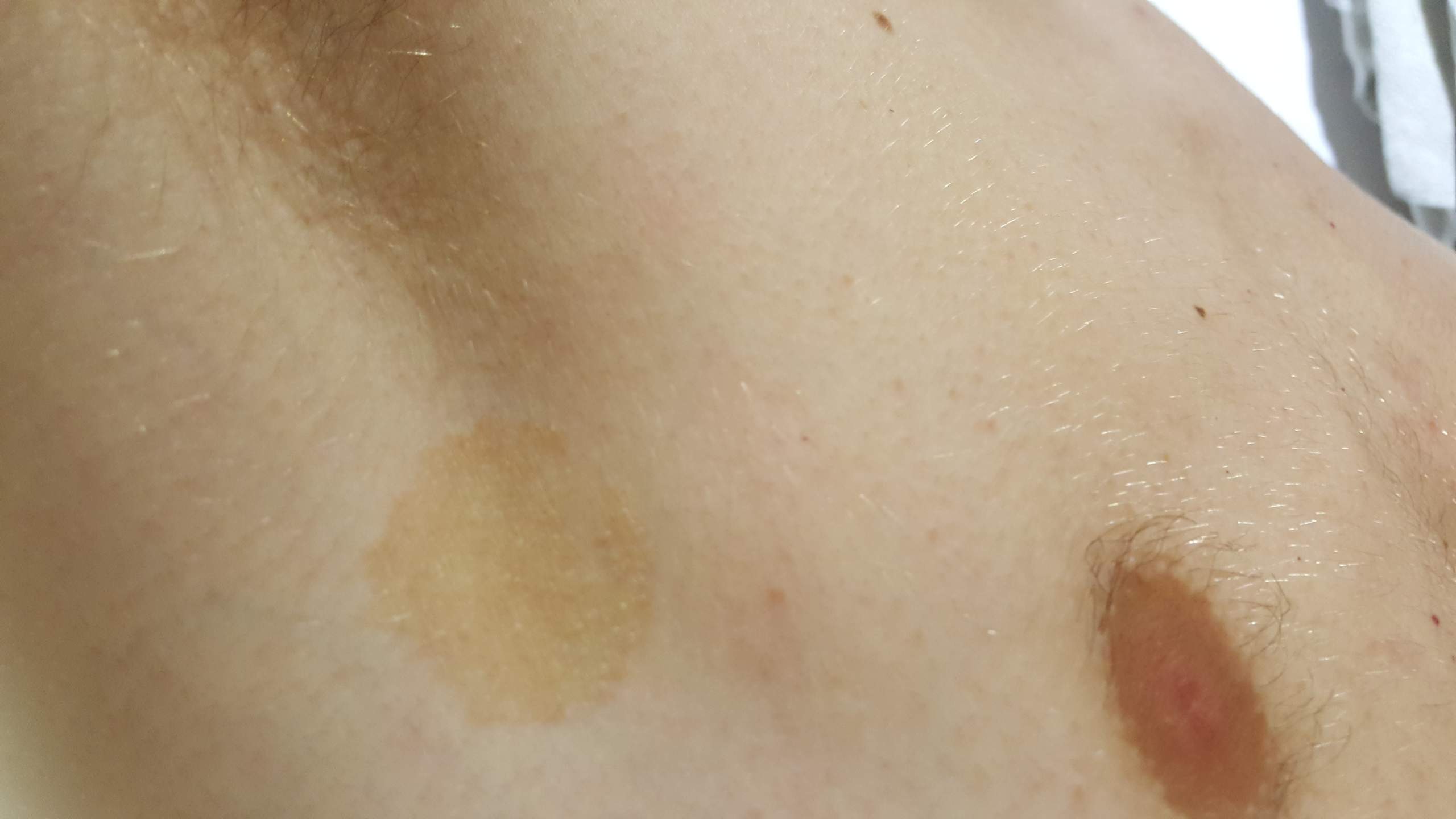 Gelbliche Flecken Auf Der Haut