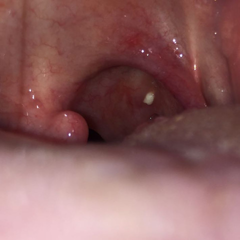 Gelber Punkt Im Hals Oder Rachen Rachen Gelber Punkt Im Hals Oder Rachen Rachen