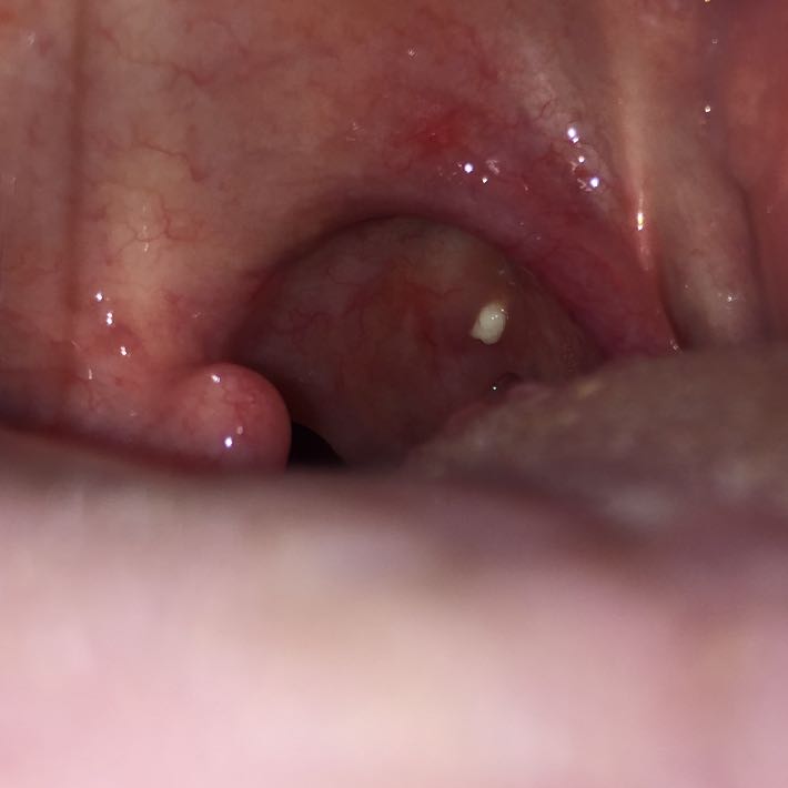 Gelber Punkt im Hals oder rachen? (RĂ€chen) pickel am hals seitlich