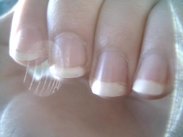 Gelber Rand Am Fingernagel Nagelpilz Fingernagel