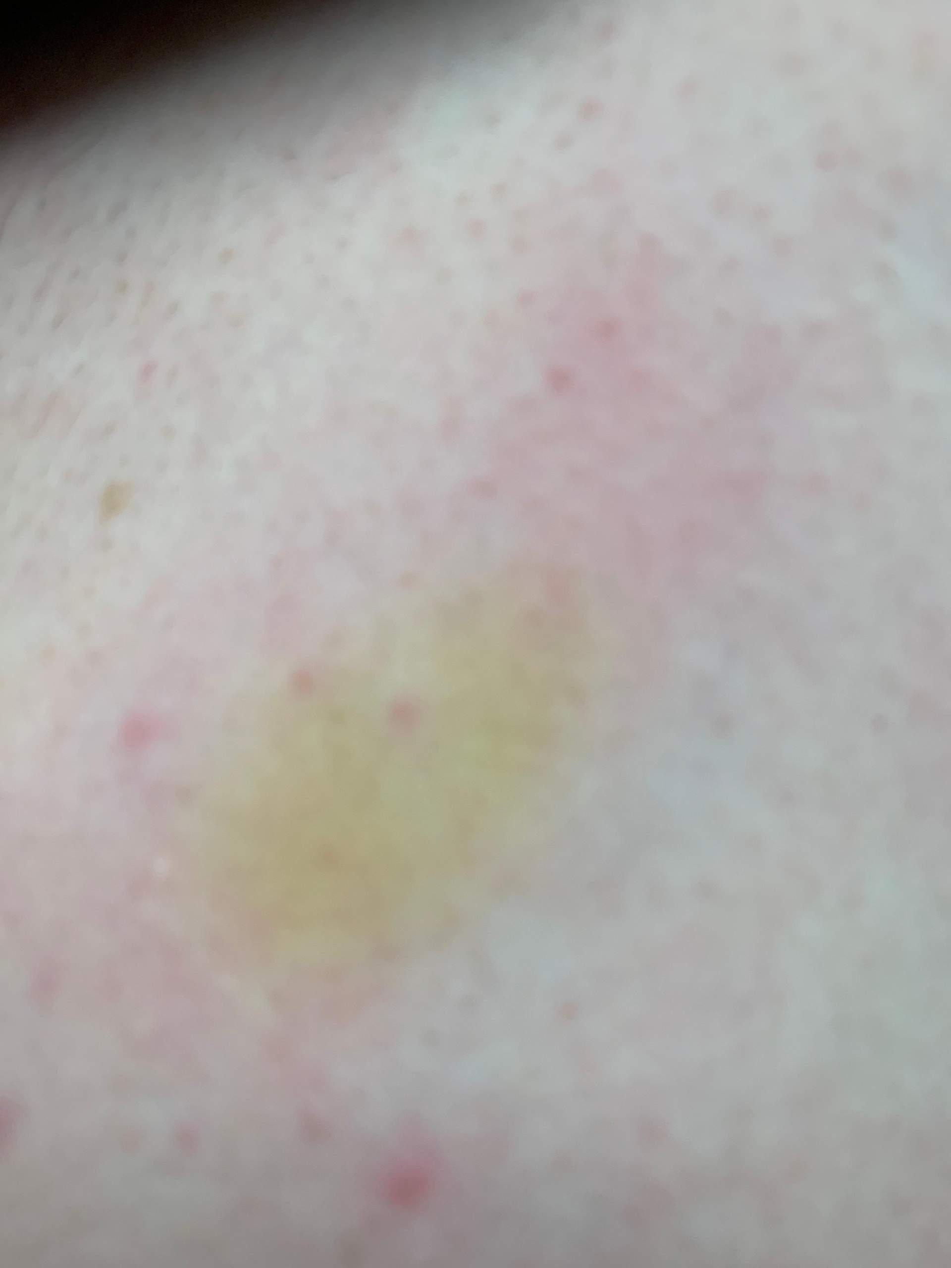 Gelbliche Flecken auf der Haut was ist das? (Gesundheit und Medizin) Gelbliche Flecken auf der Haut was ist das? (Gesundheit und Medizin)