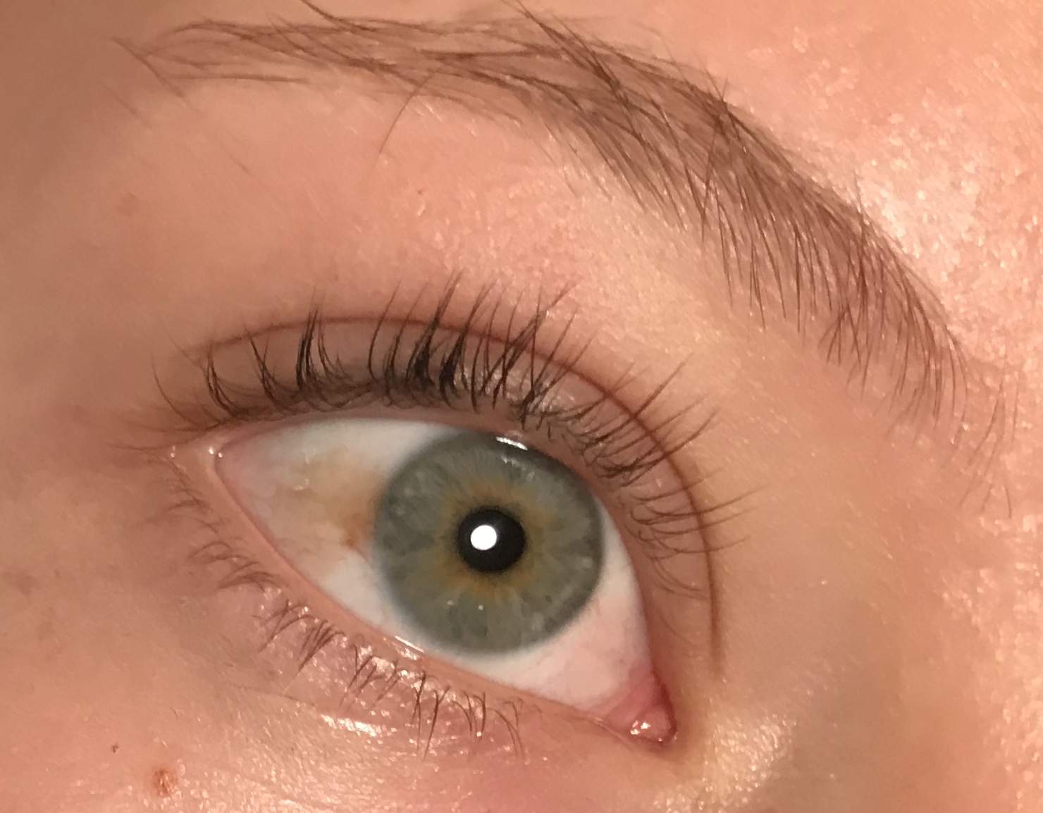 Gelbliche Verfärbung im Auge /Apfel? (Gesundheit und Medizin, Gesundheit, Krankheit) Gelbliche Verfärbung im Auge /Apfel? (Gesundheit und Medizin, Gesundheit, Krankheit)