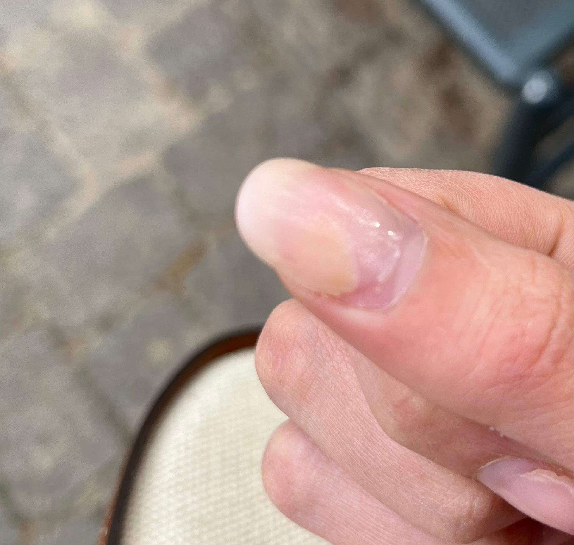 Gelngel .. nagelpilz? (Ngel, Fingerngel, Nagelstudio)