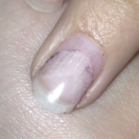 So sieht der Nagel mit den schlimmsten Liftings und den Nagellackresten aus - (Nägel, Fingernägel, Gelnägel)