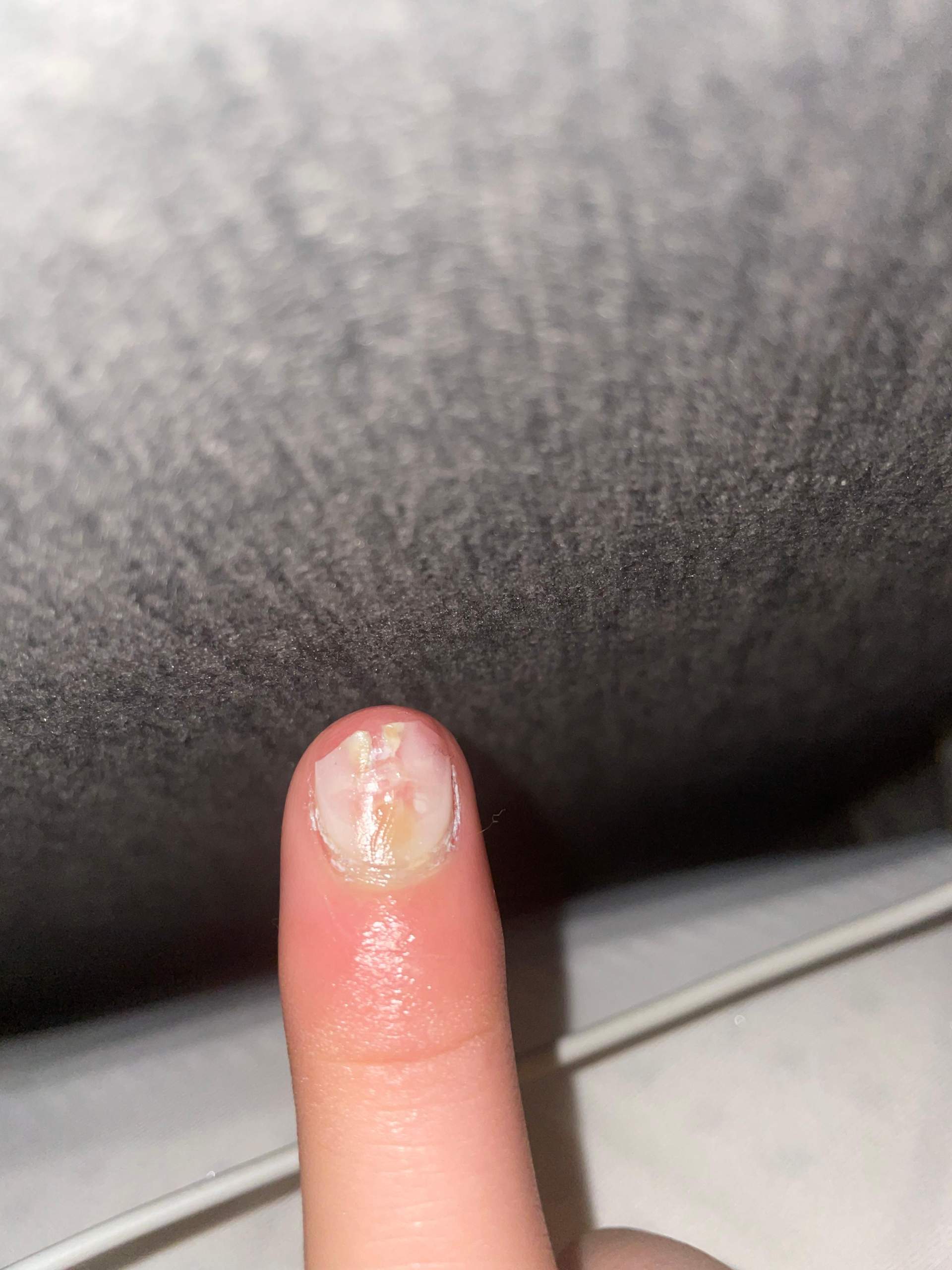 gelnagel was tun? (Entzündung, Nägel, Hand)